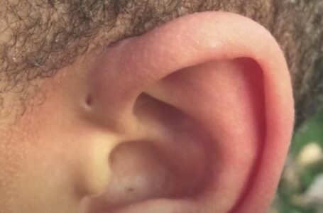 Што претставува дупчето на увото? – Вистинска реткост, воопшто не би требала да биде тука!